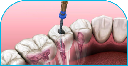 Endodoncia